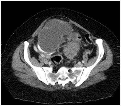 Primary Peritoneal Carcinosarcoma: A Case Report
